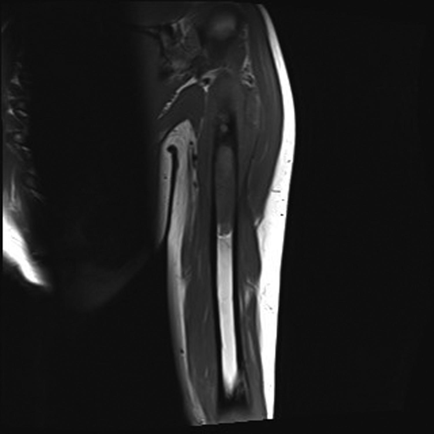 Figure 46.4, A coronal T1-weighted image of the left humerus with normal high signal (bright) fatty marrow inferiorly with an abrupt transition to an abnormal intermediate signal (relatively darker) marrow more superiorly, and this demonstrates well how reliable MRI is to show marrow abnormalities. This was an osteosarcoma.