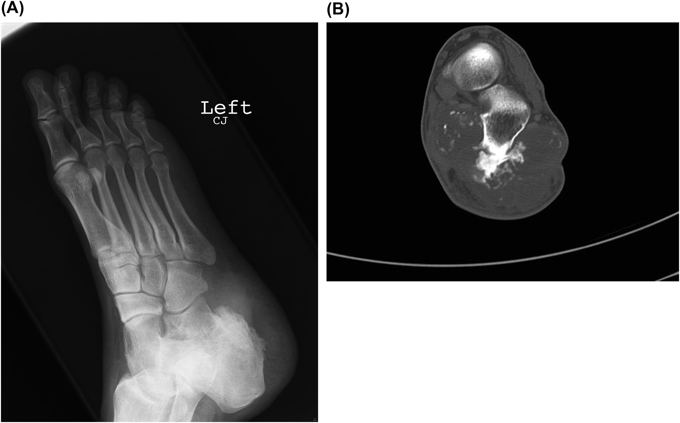 Figure 46.5, (A) An oblique radiograph of the foot with some osseous hypertrophy at the inferior calcaneus with adjacent soft tissue thickening. Mineralization of the soft tissue thickening is difficult to appreciate on the radiograph. (B) The corresponding axial CT image of the foot which nicely demonstrates chondroid mineralization in the soft tissue with a classic rings and arcs pattern. This was a chondrosarcoma in an unusual location.