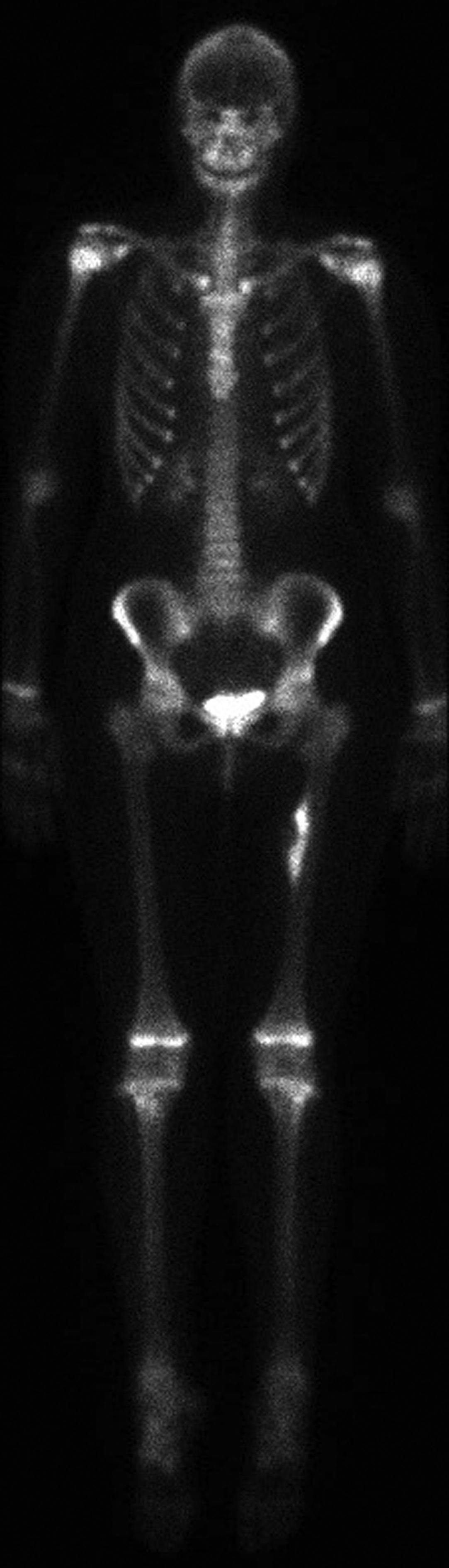 Figure 46.6, A frontal whole body image from a Tc-99m MDP bone scan with increased activity in the proximal left femur, which corresponded to a patient's primary osteosarcoma. Physiologic activity is present in the growth plates of this skeletally immature patient and also in the kidneys and bladder. No abnormal foci of increased activity was noted on this bone scan to suggest metastatic disease.