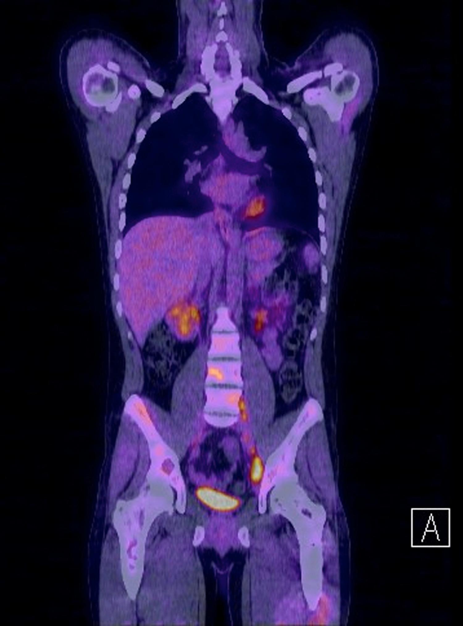 Figure 46.7, A fused frontal image from a PET/CT with increased metabolic activity corresponding with lymph nodes in the left pelvis and more subtle increased activity corresponding with lesions in the right iliac bone, acetabulum, lumbar spine, and mid-left femur in this patient with multifocal Ewing's. Contrasted with the Tc-99m MDP bone scan, PET/CT allows for better localization of abnormal hypermetabolic osseous and soft tissue lesions because of the routine use of fused images.