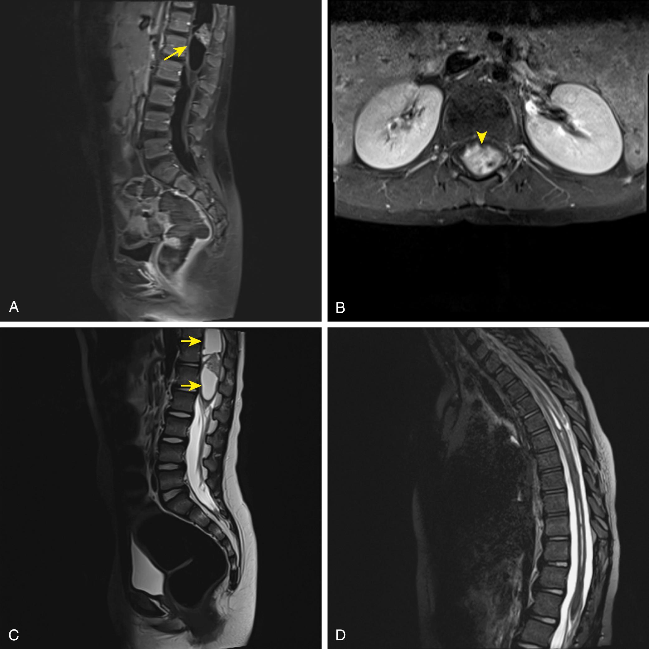 Fig. 8.1, Imaging of an intramedullary lesion consistent with astrocytoma as seen on the sagittal T1-weighted gadolinium-enhanced MRI (A, small arrow ). This tumor consists of an enhancing mural nodule seen on the axial T1-weighted gadolinium-enhanced sequence (B, arrowhead ) and a surrounding cystic area seen on the sagittal T2-weighted sequences (C, arrows ). The lesion shows characteristic findings of an intramedullary tumor as it expands the conus medullaris and fills the canal at the level of T12–L1. Postoperative MRI (D) after gross total resection of tumor resulting in decreased size of the intramedullary cyst.