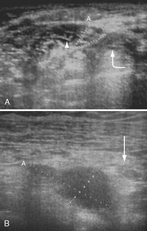 FIGURE 26-3, A , Normal ultrasonographic appearance of the trunks ( dotted lines ) of a brachial plexus, localized under the sternocleidomastoid muscle and between the anterior scalene ( arrowhead ) and middle scalene ( curved arrow ) muscles. B , Ultrasonographic study for a supraclavicular “lump” felt by the patient. The mass ( dotted lines ) does not have the typical hyperechoic hilum of a lymph node and demonstrated no flow with Doppler technique (not shown). The mass has a solid appearance suggesting a neural sheath tumor arising from the posterior cord. Arrow indicates a normal medial cord.
