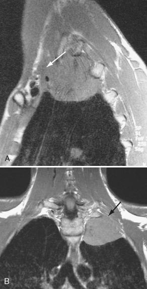 FIGURE 26-13, T1W noncontrast parasagittal ( A ) and coronal ( B ) MR images show a lung apical mass invading the adjacent soft tissues and in close proximity to the trunks and divisions of the brachial plexus. The lack of fat planes between them ( arrows ) suggests tumor invasion.