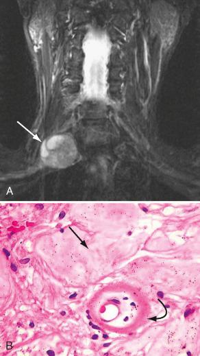 FIGURE 26-11, A , Schwannoma arising from the right brachial plexus shows heterogeneous signal in this coronal STIR image. The hyperintense areas correspond with cystic or necrotic components ( arrow ). This is explained by the tendency of the vessels to hyalinize. This phenomenon does not occur in neurofibromas where the hyperintense sign corresponds to less dense cellular myxoid tissue. B , Hematoxylin-eosin histologic preparation. Straight arrow shows a cystic area within a schwannoma and a hyalinized vessel ( curved arrow ) in the center of the image.