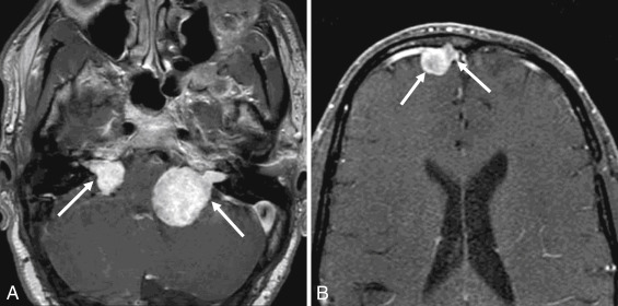 Fig. 12.1, Neurofibromatosis Type II (NF II) With Bilateral Vestibular Schwannomas and Meningioma.