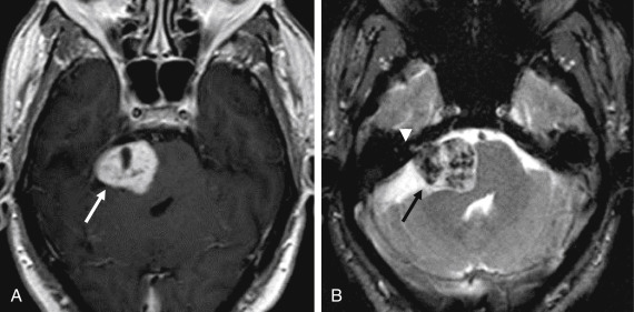 Fig. 12.4, Vestibular Schwannoma.