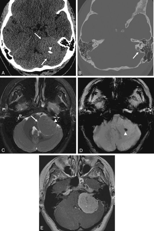 Fig. 12.6, Meningioma.