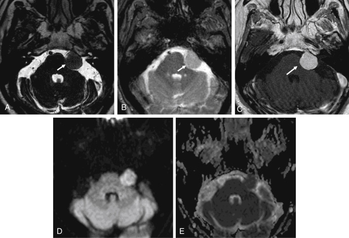 Fig. 12.7, Meningioma.