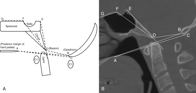Fig. 14.1, (A and B) Measurements commonly used in evaluating craniovertebral junction on lateral projection. For the name of different lines, refer to Table 14.1 . A, posterior margin of hard palate; B, opisthion; C, inferior margin of the posterior rim of foramen magnum; D, basion; E, dorsum sella; F, anterior clinoid process; G, floor of anterior cranial fossa.