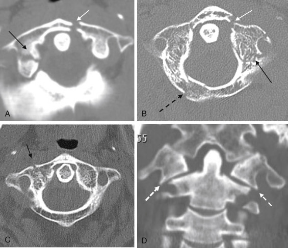 Fig. 14.11, Atlas fracture. ( A – C , axial; D , coronal reconstruction). Anterior ring fracture ( white arrow ) is shown on (A) and (B) . Lateral mass fracture ( black arrow ) is shown on (A) , (B) , and (D) . Posterior arch fracture ( dash black arrow ) is shown on (B) . Transverse foramen fracture is shown on (B) , and vertebral artery (VA) injury is suspected. (D) shows lateral displacement of bilateral atlas lateral masses with the outer border ( dash white arrows ) sliding laterally on the C2, and fracture of both arches is highly suspected.