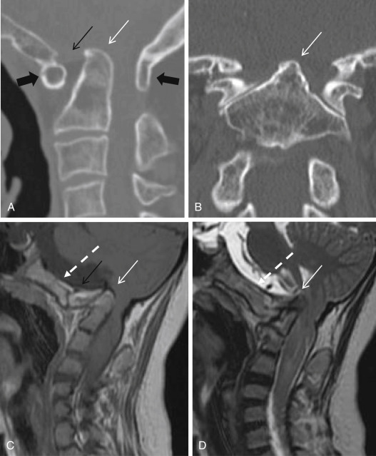 Fig. 14.2, Classic imaging findings in basilar invagination. (A) Sagittal and (B) coronal reconstruction of CT scan. (C) Sagittal T1- and (D) sagittal T2-weighted images. Key findings are odontoid process cephalad protruding into the foramen magnum ( small white arrow ) and C1-2 dislocation or dens-clivus dislocation ( small black arrow ) directly compressing the pontomedullary. The upper row is a case associated with atlas assimilation ( large black arrow ) and agenesis of occipital condyle. The lower row is another case with dysplasia of clivus ( white dotted arrow ) and partial agenesis of atlas.