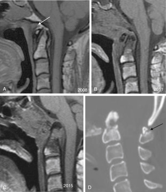 Fig. 14.3, A patient with nasopharyngeal carcinoma has secondary basilar invagination due to local bone destruction. Serial follow-up sagittal T1-weighted MR images (A – C) from 2008 to 2013. A subtle recurrent tumor was noted in the anterior supraodontal space (SOS) in 2008 ( white arrow ). In 2011, the tumor became obvious and invaded the SOS, prevertebral space, clivus, and upper C2. In 2013, the lesion converted to a diagnosis of recurrent cancer with basilar invagination. Sagittal CT reconstruction (D) shows upper displacement of the C2 and also posterior ( black arrow ).