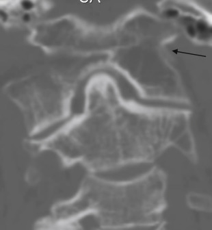 Fig. 14.5, Unilateral atlas assimilation. Coronal CT reconstruction, frontal view. In this case, the left lateral mass ( black arrow ) of C1 fuses with the occipital condyle but not the right side.