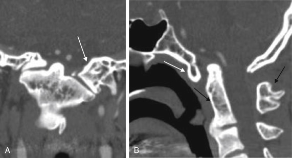 Fig. 14.6, A case ( A , coronal and B , sagittal reconstruction CT) of right occipital condyle dysplasia, left lateral mass, and anterior C1 assimilation ( white arrows ) associated with Klippel-Feil anomaly ( black arrow ). Basilar invagination is evident on sagittal view.