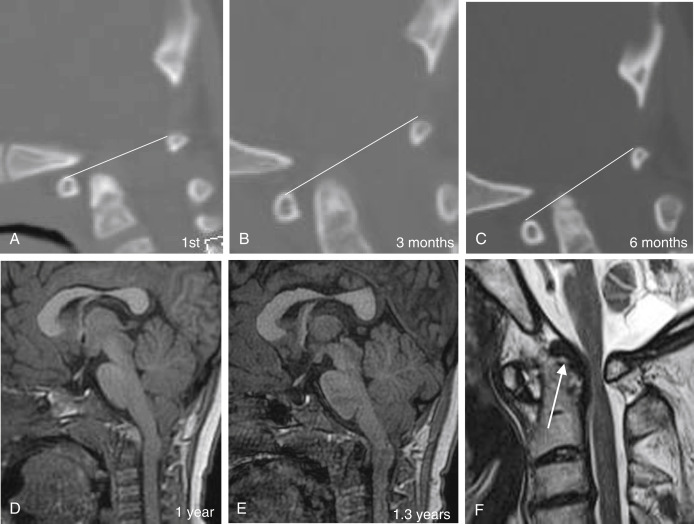 Fig. 14.7, Dislocation of the atlantoaxial joint and stages of reducible instability progressing to irreducible and basilar invagination. (A – C) Serial follow-up sagittal reconstruction CT and (D) and (E) sagittal T1-weighted image after last CT of the same patient. From (A) to (B) , the dens moves posteriorly, increasing the distance of the atlantodental space; from (B) to (C) , the dens ascends into the foramen magnum; note the distance from the line between the upper margins of the anterior and posterior arches of C1. The distance from the tip of the dens is shortening between the serial studies. Compare (D) and (E) , there is more indentation of dens to the pontomedullary junction. (F) Another patient with atlantoaxial dislocation. Sagittal T2-weighted image shows granulation tissue formation at the top of the dens ( white arrow ). This can prevent the further upward movement of the dens.