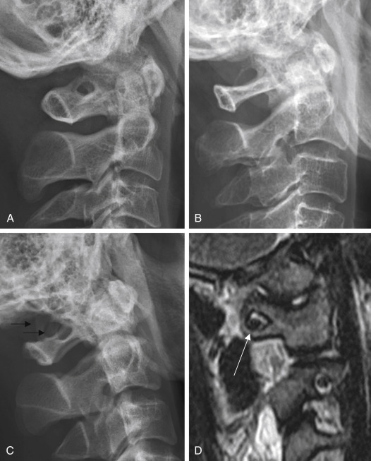 Fig. 14.8, Cases of ponticulus posticus. (A) Complete type; (B) calcified type; (C) bilateral involvement ( black arrows ); (D) the vertebral artery goes through the ponticulus posticus ( white arrow ).