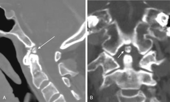 Fig. 14.9, Persistent ossiculum terminale ( white arrow ) ( A , coronal; B , coronal reconstruction) located above the alignment of upper C1 and the dens, between the dens and the lowest end of the clivus.