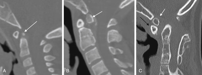 Fig. 14.10, Os odontoideum. Two types ( A , orthotopic type and B , dystopic type) of os odontoideum are shown on the sagittal view of reconstruction CT. The os ( white arrow ) moves in different relationship to the clivus and the rest of C2. Please note the round or triangular shape of the anterior arch of C1 ( black arrow ). With associated Klippel-Feil anomaly basilar invagination resulted (C) .