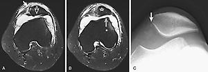 FIG 12.1, Transient Patellar Dislocation