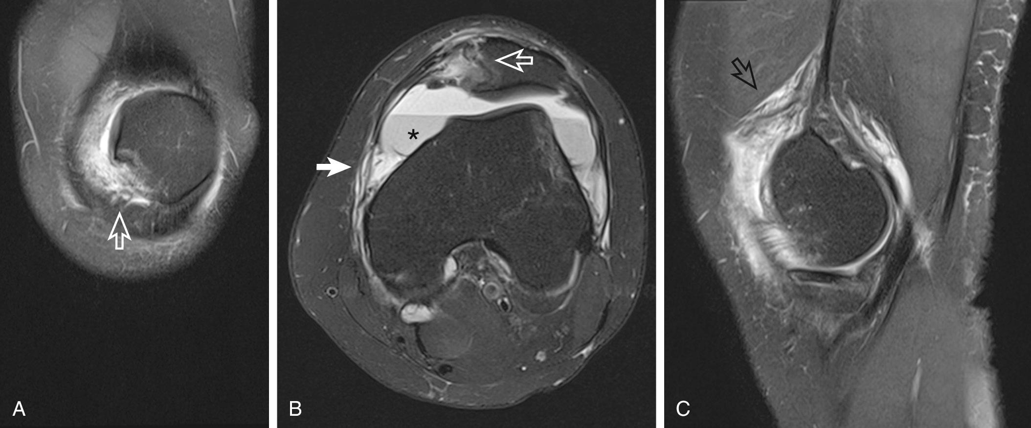 FIG 12.2, Transient Patellar Dislocation