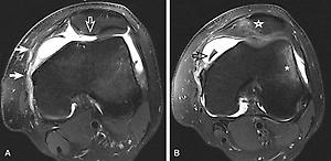 FIG 12.3, Transient Patellar Dislocation