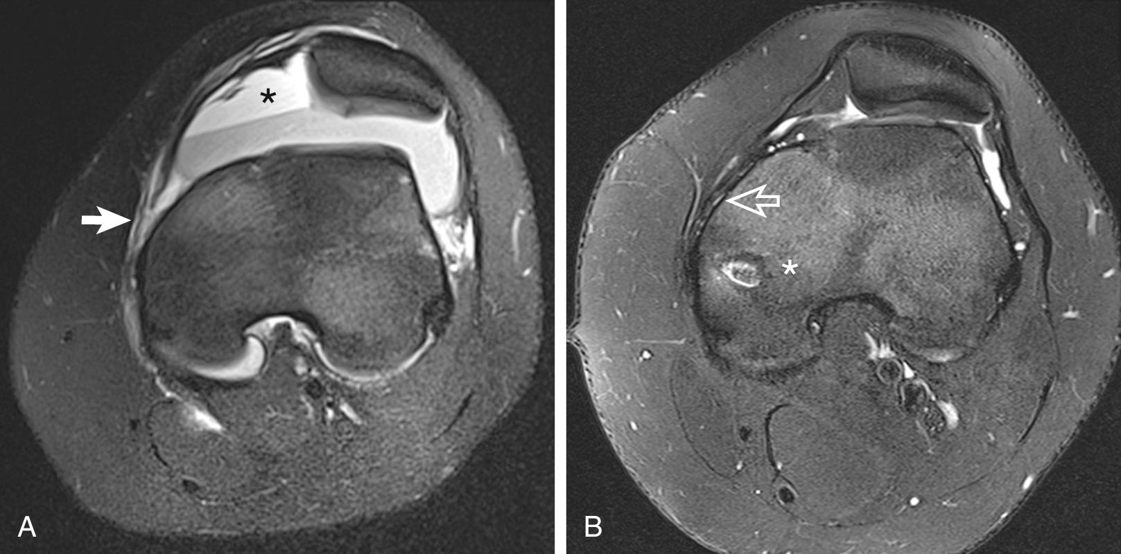 FIG 12.5, Transient Patellar Dislocation