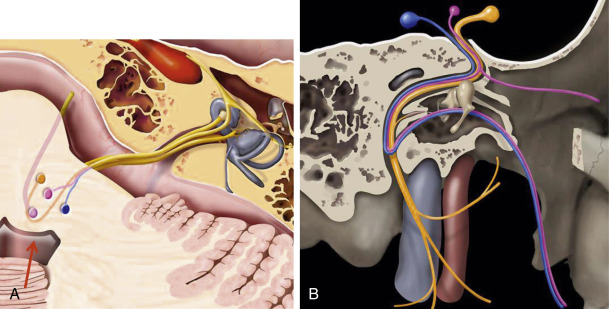 Fig. 9.1, The nuclei of the facial nerve (A) . Motor nucleus (orange), nucleus tractus solitarius (blue), superior salivatory nucleus (pink). Note that the facial nerve loops around the abducens nucleus ( red arrow ) to form the facial colliculus. Image (B) is a sagittal oblique graphic image demonstrating the components of the facial nerve with the motor component (yellow), the secretomotor fibers in the chorda tympani (blue), and the parasympathetic fibers that exit through the greater superficial petrosal nerve (purple).