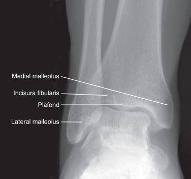 Fig. 112.1, An anteroposterior standing radiograph of the ankle.