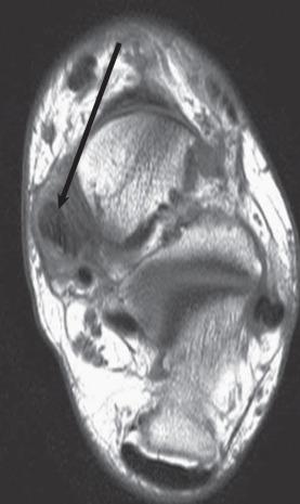 Fig. 112.11, An axial T1-weighted image with infiltration of the normally low signal intensity of the posterior tibial tendon with intermediate (gray) signal (arrow) .