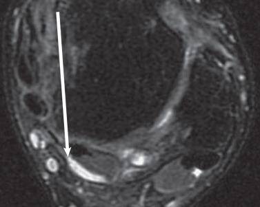 Fig. 112.12, An axial T2-weighted image with high signal intensity (arrow) adjacent to the flexor hallucis longus at the posterior aspect of the talus.