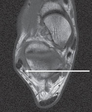 Fig. 112.13, A T1-weighted axial image of the ankle highlighting the presence of a peroneus quartus (arrow) . The tendon is a small-caliber low signal intensity structure located posterior within the peroneal retinaculum. Proximally the tendon has its own muscle belly and typically will insert on the calcaneus.