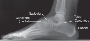 Fig. 112.2, A lateral standing radiograph of the foot.