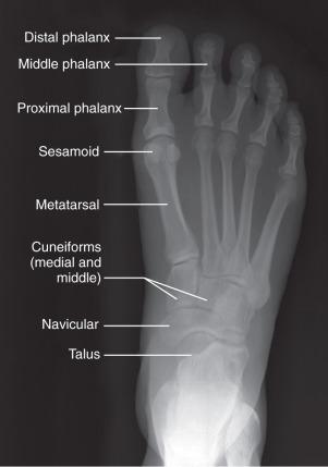 Fig. 112.3, An anteroposterior standing radiograph of the foot.