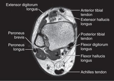 Fig. 112.4, An axial T1-weighted magnetic resonance image of the distal leg. The tendons at this level are denoted.