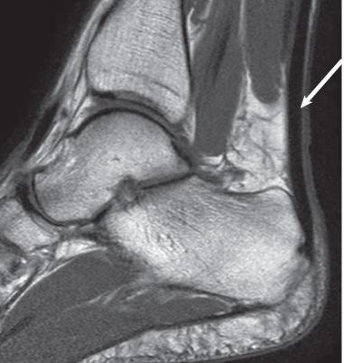 Fig. 112.5, A T1-weighted image of a normal Achilles tendon. Note the uniform thickness and the low signal intensity of the tendon (arrow) .