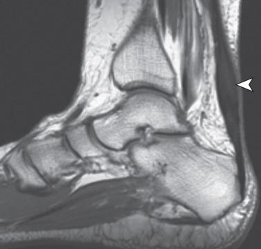 Fig. 112.6, A T1-weighted magnetic resonance image of a patient with noninsertional Achilles tendinosis. Note the intermediate signal intensity and fusiform thickening of the tendon (arrowhead) .