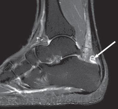 Fig. 112.7, A T2-weighted fat-saturated image with a teardrop high signal intensity immediately anterior to the Achilles at the level of the calcaneus is consistent with retrocalcaneal bursitis (arrow) .