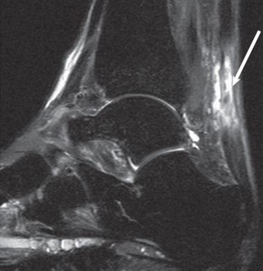 Fig. 112.8, A T2-weighted magnetic resonance image of an acute Achilles rupture. Note the high signal intensity (arrow) that completely disrupts the low signal of the Achilles tendon.