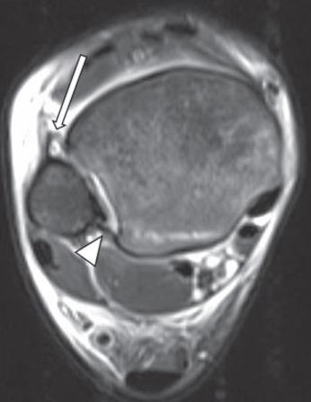 Fig. 112.9, A T2-weighted magnetic resonance image of acute syndesmotic injury. Anteroinferior tibiofibular ligament (arrow) is disrupted with surrounding high signal intensity. Posteroinferior tibiofibular ligament (arrowhead) is intact with associated nondisplaced posterior distal tibial fracture signifying a high- grade syndesmotic injury.