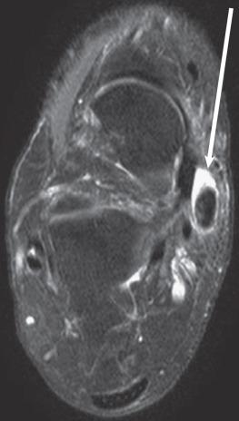 Fig. 112.10, An axial T2-weighted image of a patient with tenosynovitis of the posterior tibial tendon. Note the high signal intensity (fluid) adjacent to the tendon (arrow) .