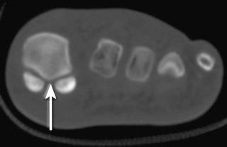 FIGURE 36–1, Coronal CT image through the first metatarsal head and hallucal sesamoid. The medial (tibial) and lateral (fibular) sesamoids straddle the crista (arrow), a longitudinal bony ridge at the plantar surface of the first metatarsal head.