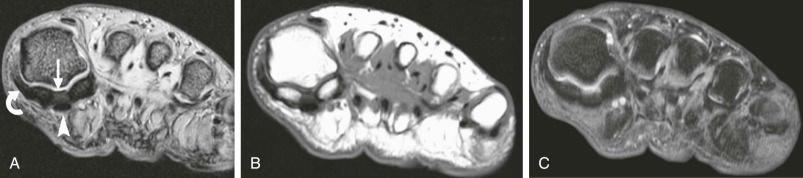 eFIGURE 36–1, A , Coronal, gradient-recalled-echo 2D MR image through the level of the first metatarsal-sesamoid articulation shows the intersesamoid ligament portion of the plantar plate (straight arrow). The flexor hallucis longus tendon (arrowhead) is cradled between the hallucal sesamoids, plantar to the intersesamoid ligament. Shown is the medial aspect (curved arrow) of the fibrous joint capsule. B , T1-weighted MR image permits evaluation of osseous contours and marrow signal alteration. C , Fat-suppressed, T2-weighted MR image permits detection of marrow edema, synovitis, tenosynovitis, capsuloligamentous, or myotendinous signal abnormalities.