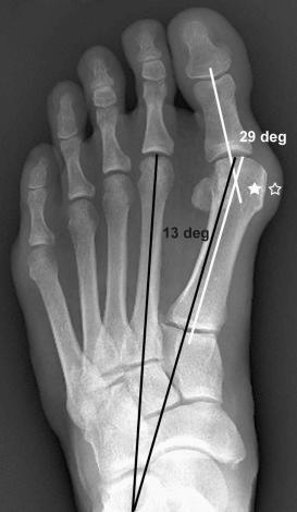 FIGURE 36–2, Anteroposterior weight-bearing radiograph of the left foot illustrates the hallux valgus angle of 29 degrees ( white lines , normal is <15 degrees) and the first intermetatarsal angle of 13 degrees ( black lines , normal is between 8 and 12 degrees), indicative of moderate hallux valgus and mild metatarsus primus varus. The bony and soft tissue bunions are indicated by stars.