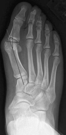 eFIGURE 36–2, Anteroposterior weight-bearing radiograph of the right foot in an individual with severe hallux valgus. The proximal articular set angle (PASA) is the angle between a line bisecting the long axis of the first metatarsal and a line perpendicular to the articular margins of the first metatarsal head. The normal PASA angle ranges from 0 to 8 degrees.