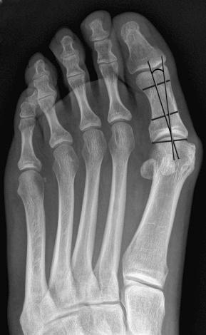 eFIGURE 36–3, Anteroposterior weight-bearing radiograph of the left foot in an individual with hallux valgus illustrates the distal articular set angle (DASA), which is the angle formed between the longitudinal bisection of the proximal hallux and the perpendicular to the proximal articular surface. The normal DASA angle ranges from 0 to 8 degrees.