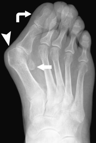 FIGURE 36–3, Anteroposterior weight-bearing radiograph shows severe hallux valgus. There is fibular deviation and subluxation of the great toe (curved arrow) and fibular subluxation of the sesamoids (straight arrow). The articular surface of the medial head of the first metatarsal (arrowhead) is laid bare and is prone to external forces of footwear and bunion formation.