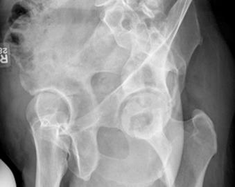 Fig. 29.3, False profile view of the right hip. The patient is standing with the body rotated 65 degrees, with the right side rotated posteriorly toward the cassette. The x-ray beam is centered at the femoral head.