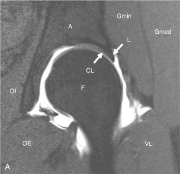 Fig. 29.4, (A–C) Direct magnetic resonance arthrography T1-weighted images with fat suppression in the (A) oblique coronal, (B) oblique sagittal, and (C) oblique axial planes, with key anatomic structures labeled. A, Acetabulum; CART, hyaline cartilage; CL, chondrolabral junction; F, femoral head; Gmax, gluteus maximus; Gmed, gluteus medius; Gmin, gluteus minimus; GT , greater tuberosity; IL, iliofemoral ligament/anterior capsule; IP, iliopsoas; L, labrum; OE, obturator externus; OI, obturator internus; RF, rectus femoris; VL, vastus lateralis.