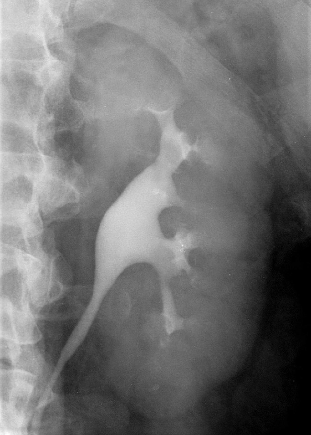 Fig. 6.1, A normal kidney as visualized by an intravenous urogram.