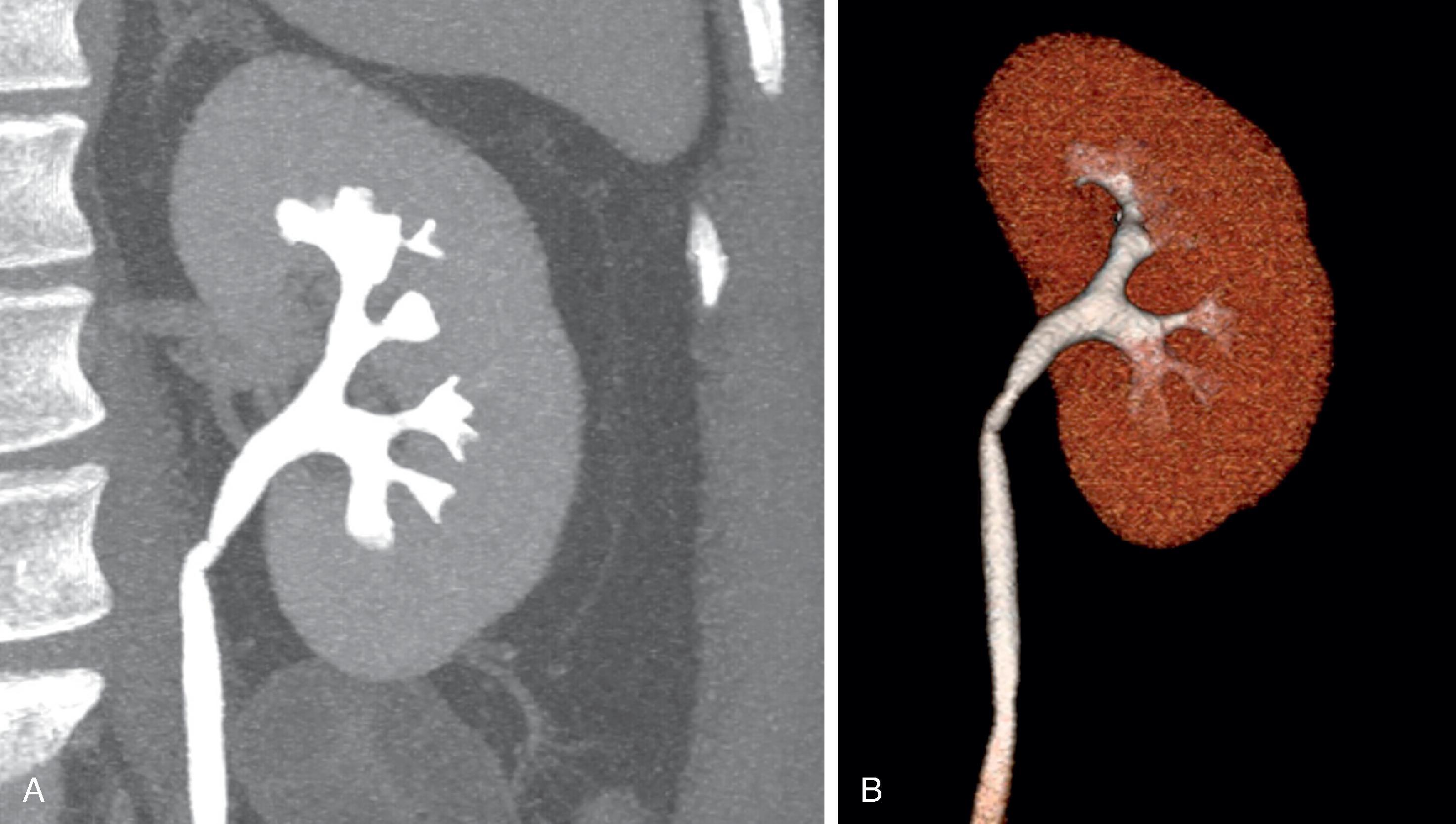 Fig. 6.2, (A) Normal kidney is shown in the coronal plane during the excretion phase of a CT urogram. This same kidney has been modeled in 3D using the source CT images (B).